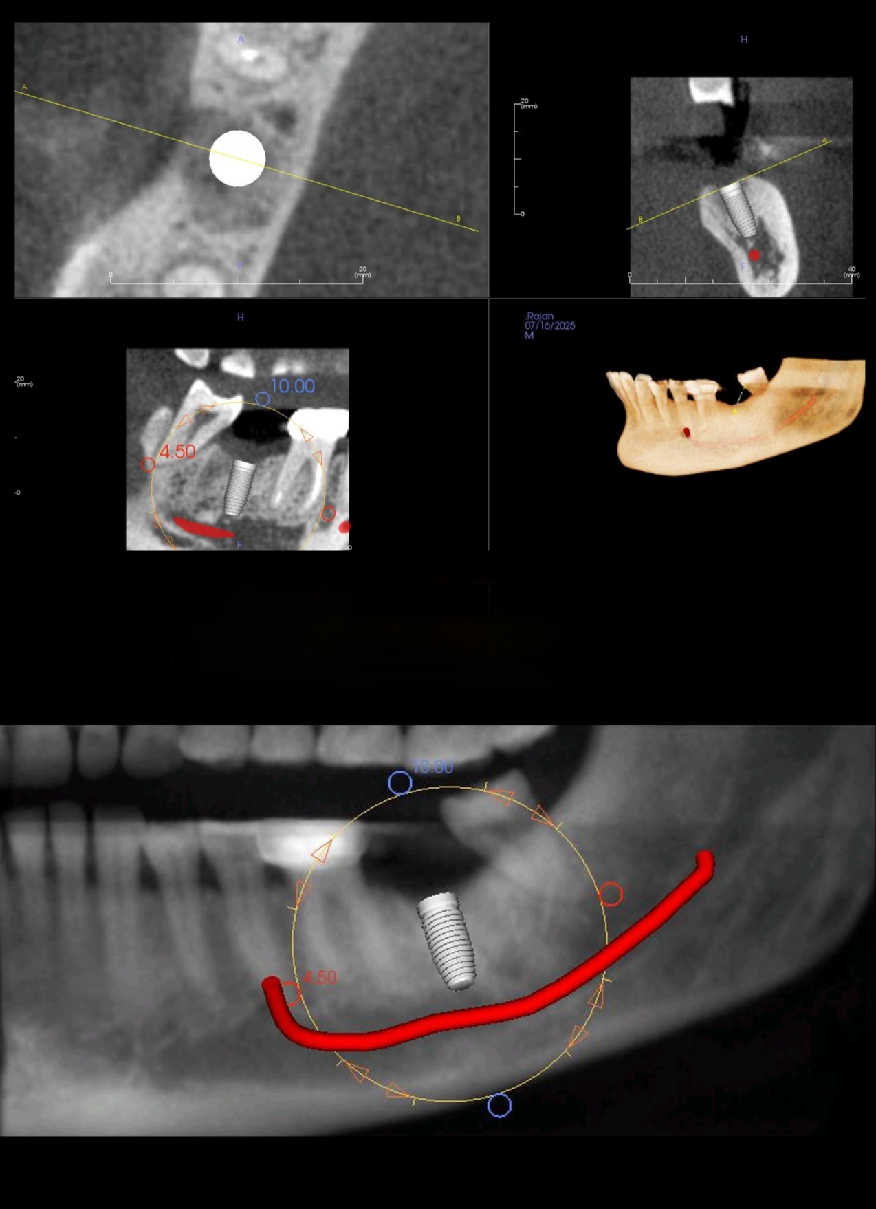3D Treatment Planning