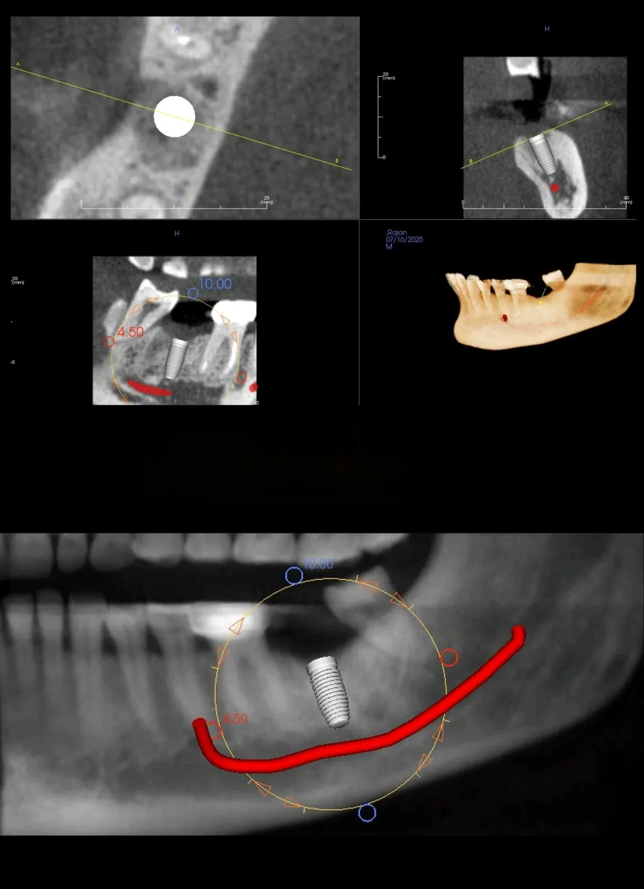 3D Treatment Planning